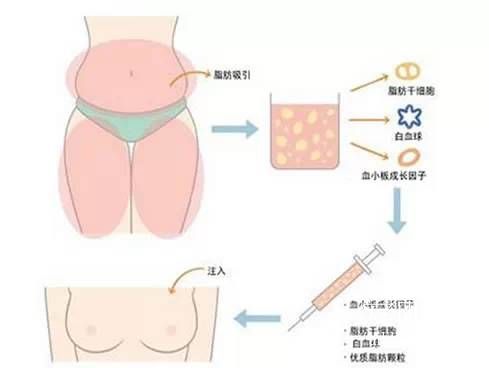  Breast augmentation surgery with autologous fat. jpg