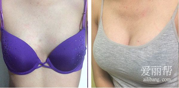  +Self fat breast augmentation.jpg