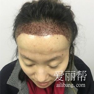 上海植发际线术后效果图,告别大额头啦!