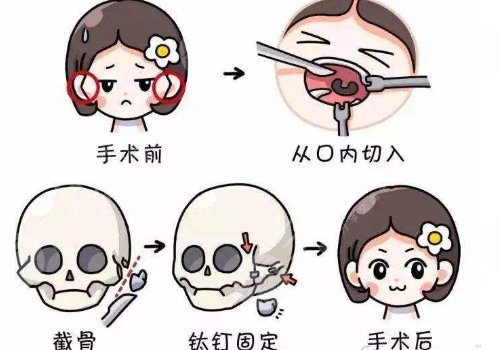  Which doctor is better for Beijing to unite with Rigo to make mandibular angle and zygomatic bone