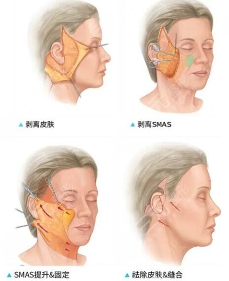  How about the case of pulling skin by the family doctor of Guangzhou Chinese Family Medicine