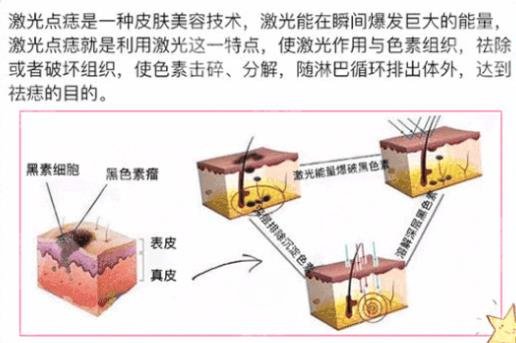 中山大学附属第一医院激光点痣多少钱