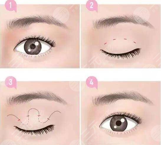  Can the plastic surgery department of Datong Third Hospital do double eyelid surgery