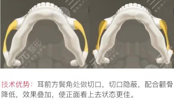  Which is the best one in Nanjing Bone Grinding and Plastic Surgery Hospital