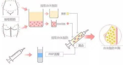 北京自体脂肪丰胸医院排行榜