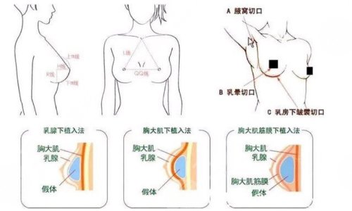  How much is the prosthesis withdrawn from Shanghai Jiuyuan