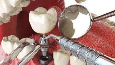  Ranking of Top 10 Private Dental Hospitals for Dental Implants in Beijing