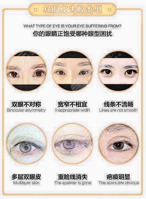  Which hospital is better for eye repair in Zhengzhou