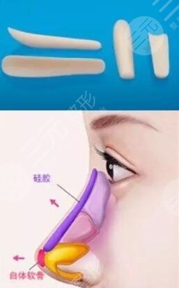  Shenzhen Fuhua nose augmentation