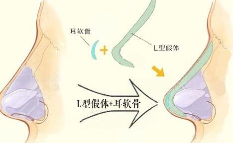  How about Suzhou Meibei having nose surgery