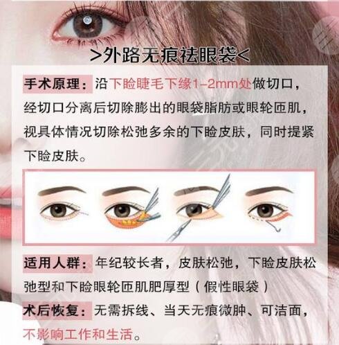  How about the eye bag removing technology of Shantou Elizabeth Plastic Hospital