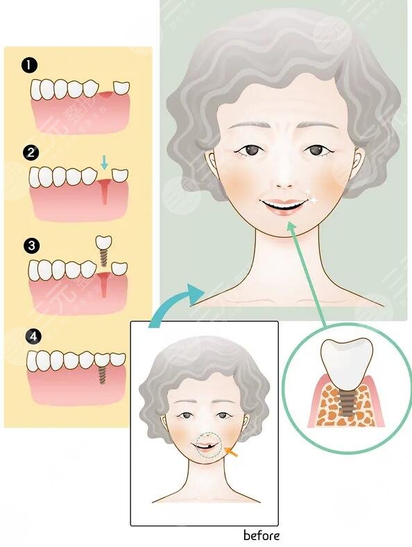  2022 Taiyuan dental implant ranking