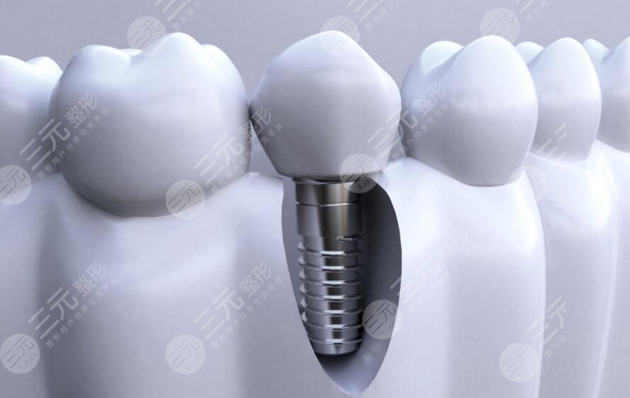  Ranking of Jinan Dental Implant Hospital in 2022