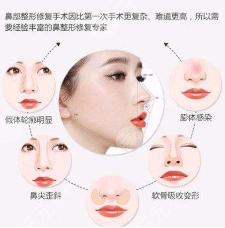  How about Suzhou Meibei having nose surgery