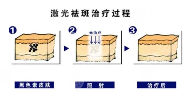  How about freckle removal in Handan Central Hospital