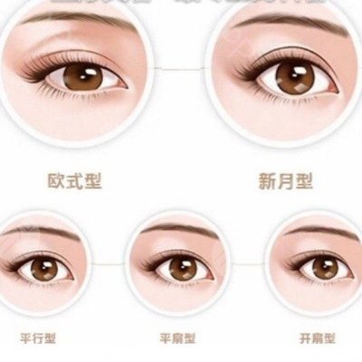  How long will it take to recover from double eyelid surgery