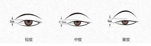  Can't make eye diagram of double eyelids