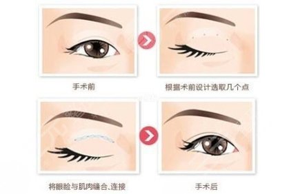  How about Shu Maoguo's double eyelids