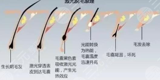  List of regular hospitals for laser hair removal in Xiamen in 2022