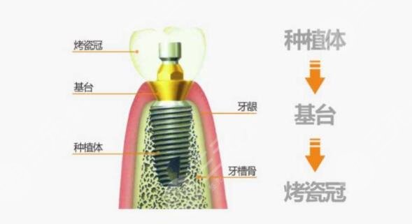  Which is reliable for dental implant in Beijing