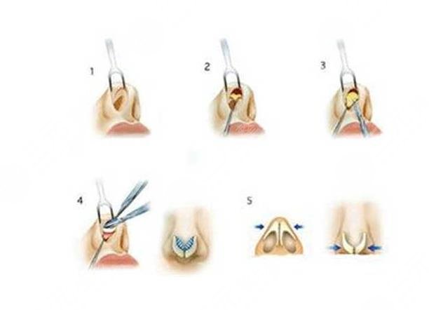  Sharing of 1-7 day recovery process chart of rib augmentation rhinoplasty