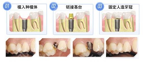  Top 5 hospitals with good dental implants in Wuhan