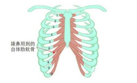 肋软骨隆鼻手术多少钱