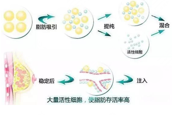  How about Liu Chengsheng making autologous fat