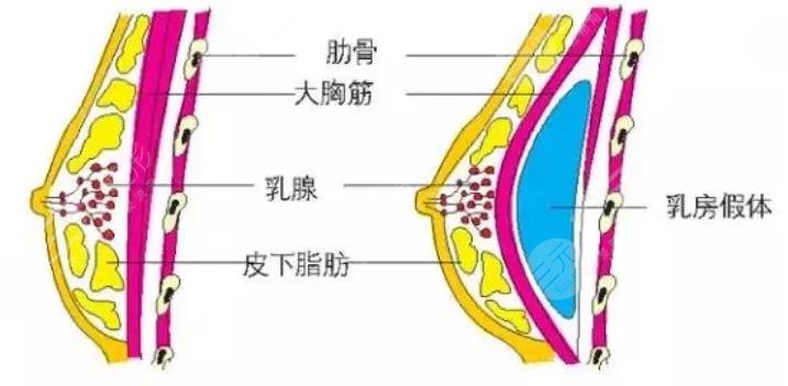 国内隆胸医院排名