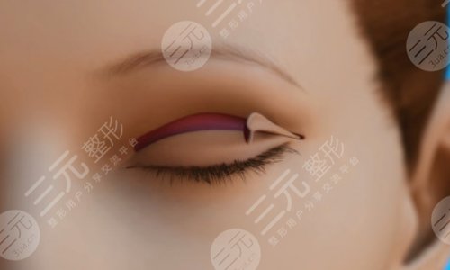  How about Feng Chuanbo doing double eyelid repair in Nanfang Hospital