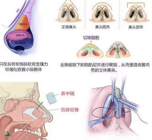  Shanghai Nose King Ranking Update