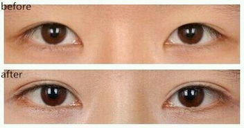  What are the methods of eyelid surgery in Xi'an Xijing Hospital