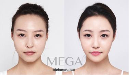  Price list of double eyelid of Chengdu Xichan Plastic Surgery Hospital