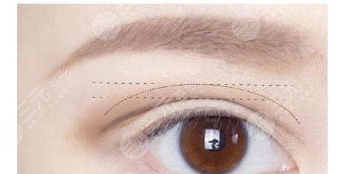  How long will it take to return to normal after total eyelid removal