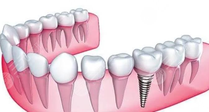  2022 Guangzhou's cheap and good dental ranking update