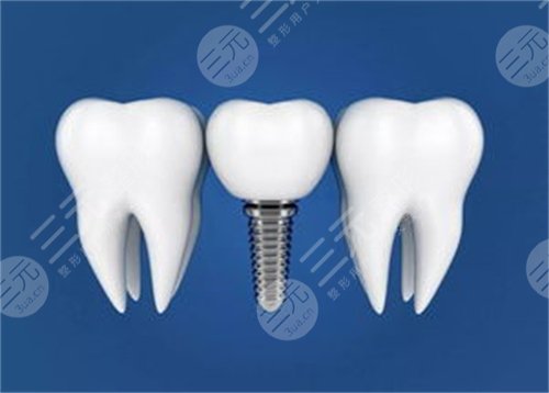  Who are the doctors with good implant skills in Hangzhou