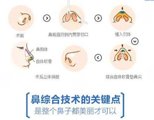  Ranking of rhinoplasty experts from Shanghai Jiuyuan Hospital