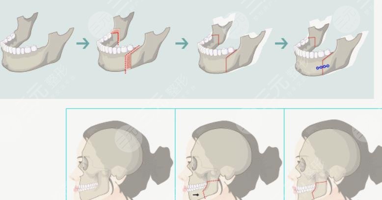  How about orthognathic surgery in Shenzhen People's Hospital