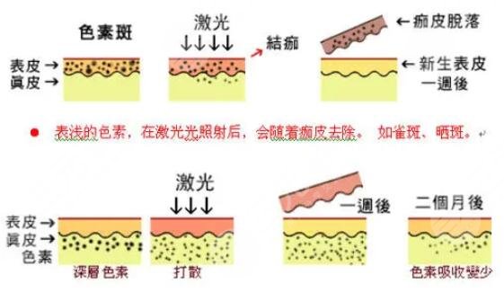 李大铁非剥脱祛斑好吗