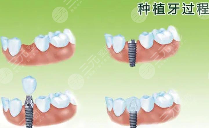  Which hospital is cheap and good for dental implant in Beijing