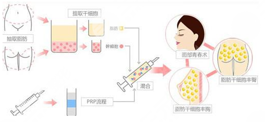 上海联合丽格李鸿君脂肪面部填充怎样