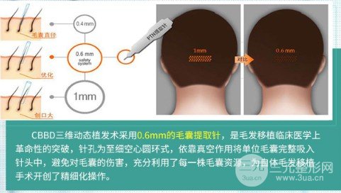 荔湾区人民医院植发怎么样