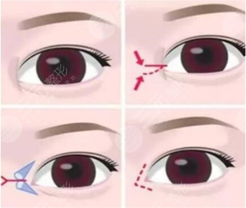  Ranking of experts in Beijing double eyelid repair