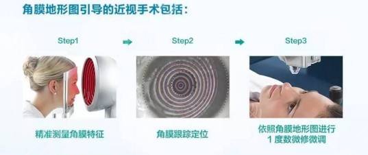  Which hospital is better for laser surgery of myopia in Guangzhou