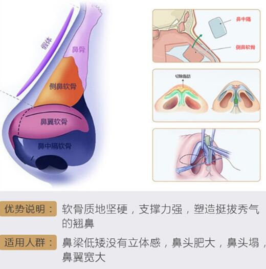  How about Hangzhou Huashan Cheng Lin's nose