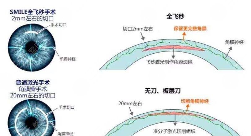  2022 Shenzhen Laser Myopia Surgery Third Class Hospital Ranking Announced