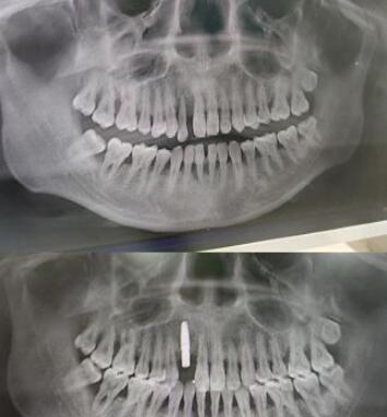  Which dental hospital in Shanghai has good dental implant