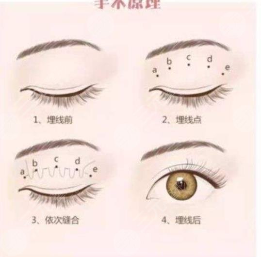  2022 Chengdu double eyelid expert ranking top 5