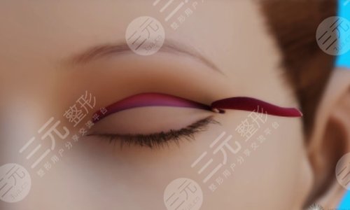  How long will it take to recover from double eyelid surgery