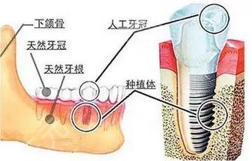 五十多岁是否适合种牙